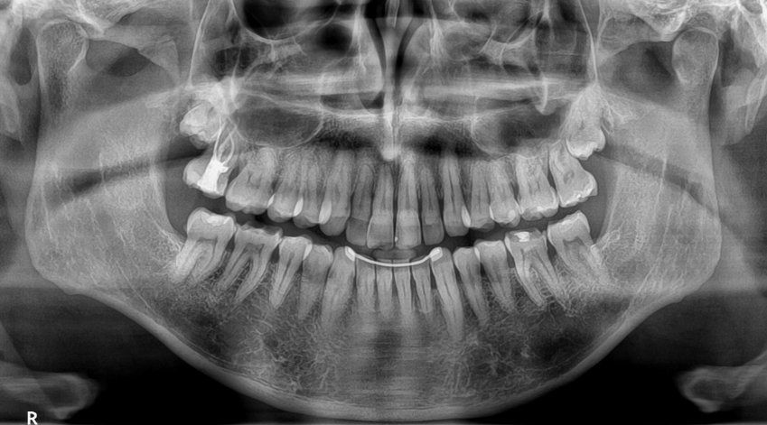 Ortopantomografía en Madrid | Imagen Diagnóstica Dental Dr. Mayor