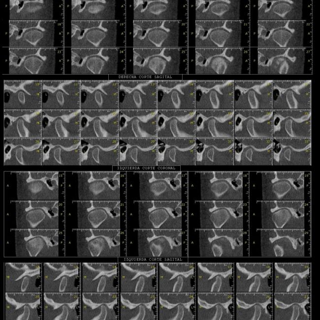 Estudios ATM en Madrid | Imagen Diagnóstica Dental Dr. Mayor