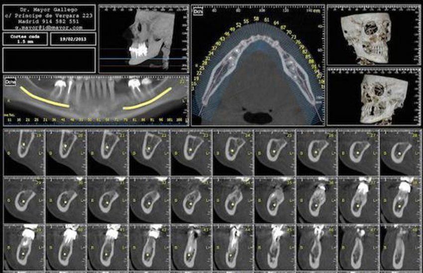 Dentascan 3D para mejorar el diagnóstico de los pacientes