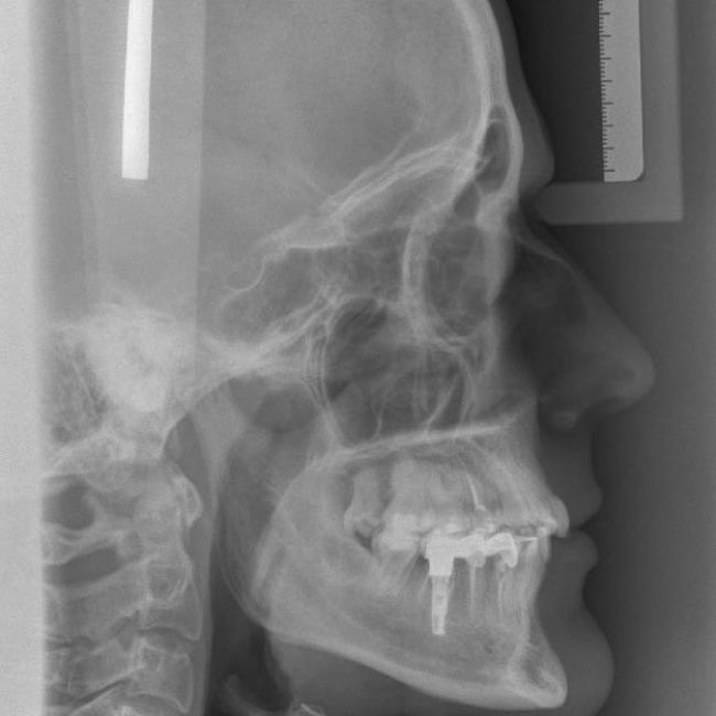 Telerradiografía lateral de cráneo en Madrid | Imagen Diagnóstica Dental Dr
