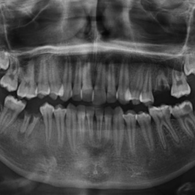 Radiografía panorámica dental