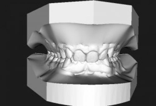 Nuevo Escaner Intraoral