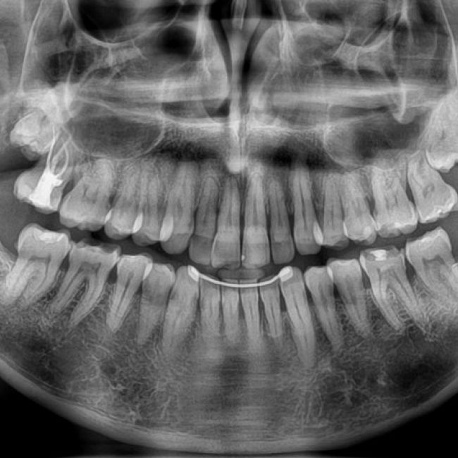Ortopantomografía en Madrid | Imagen Diagnóstica Dental Dr. Mayor