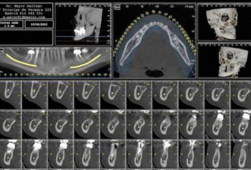 Dentascan 3D para mejorar el diagnóstico de los pacientes