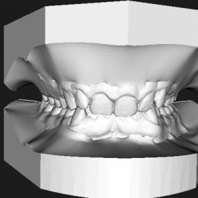 Nuevo Escaner Intraoral