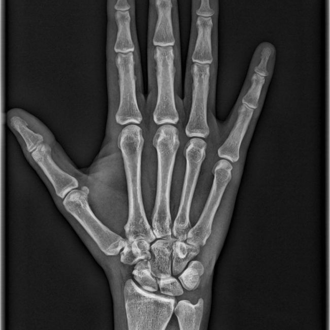 Conoce tu edad ósea con radiología del carpo en tu mano izquierda