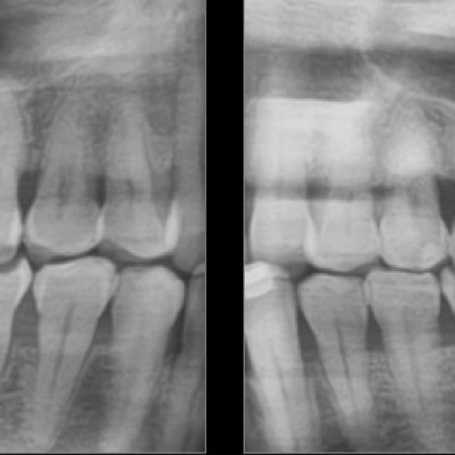 Radiografías intrabucales en Madrid